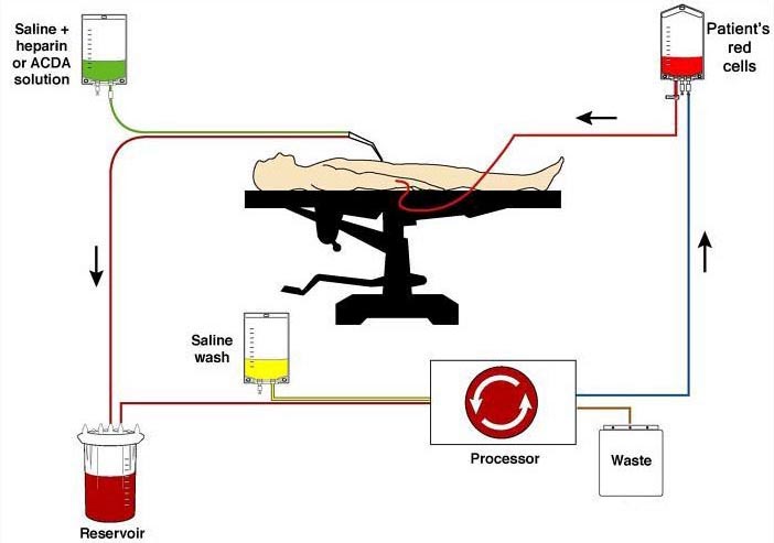 Blood-transfusion options